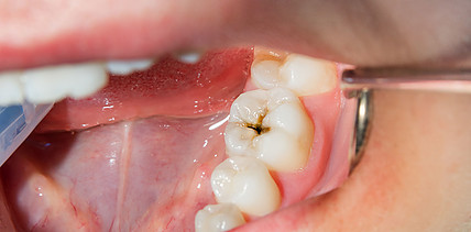 Vitalerhaltung der Pulpa bei kariösen bleibenden Zähnen – Was ist heute möglich?