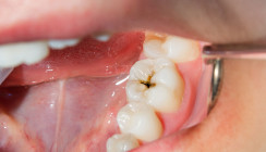 Vitalerhaltung der Pulpa bei kariösen bleibenden Zähnen – Was ist heute möglich?