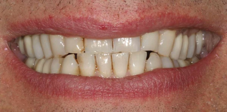 Vollkeramische Frontzahnversorgung am bruxierenden Patienten