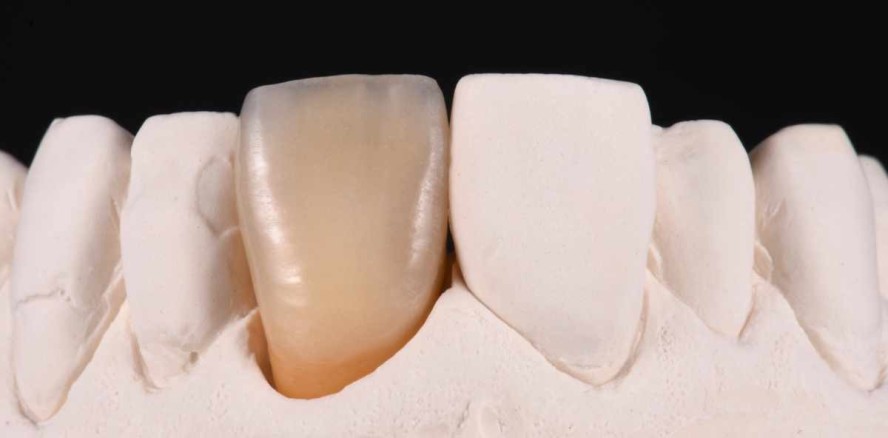 Eine vollkeramische Restauration an Zahn 21