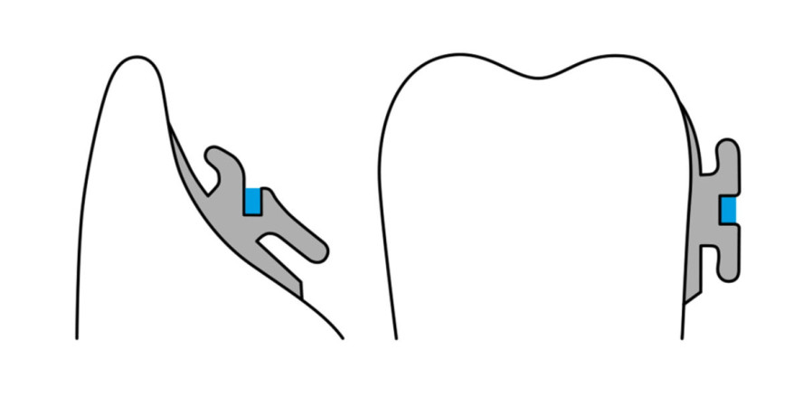 Die Nivellierung der Spee-Kurve im Unterkiefer mit der WIN-Apparatur