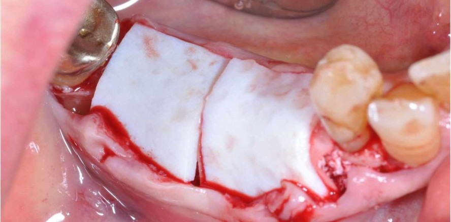 Weichgewebeaugmentation mit azellulärer dermaler Matrix