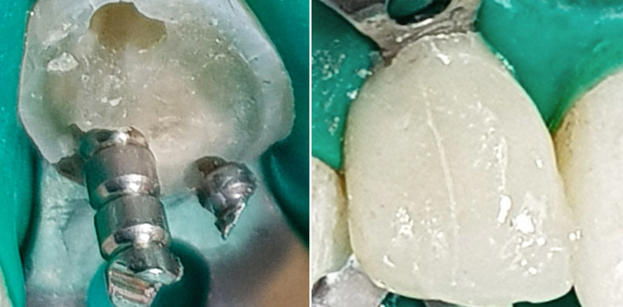 Der Kompositaufbau beim Frontzahn mit Pins und Wurzelschraube