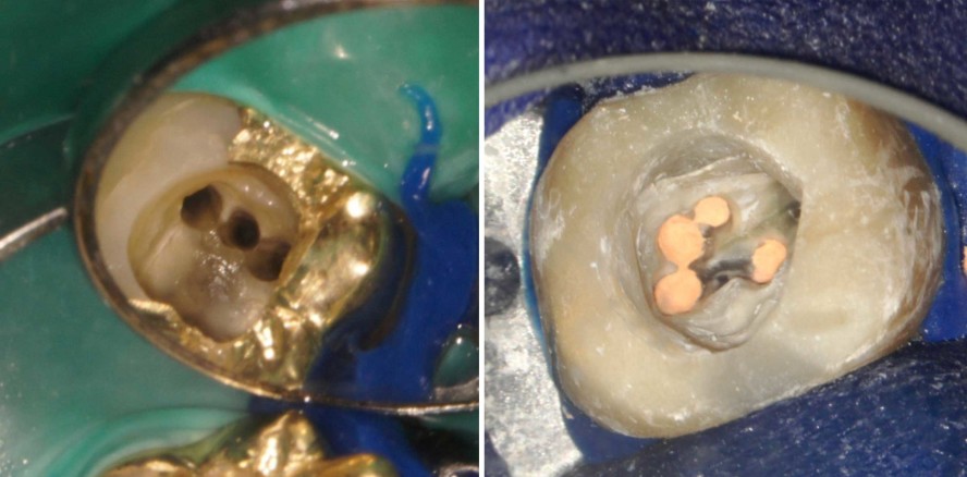 „Well begun is half done“: Darstellung von Wurzelkanälen – Teil 2