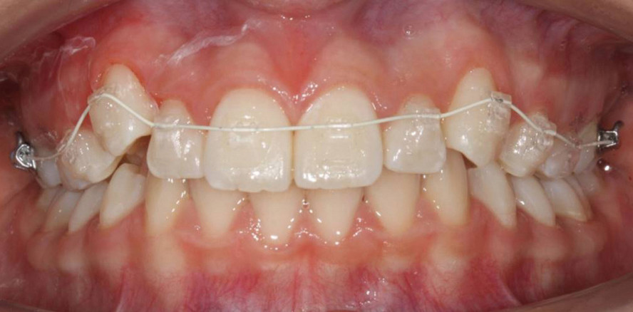 Kieferorthopädische Hybridtechnik