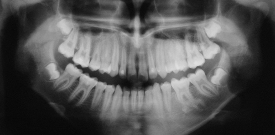 S-förmige Wurzelangulation durch einen retinierten überzähligen Zahn