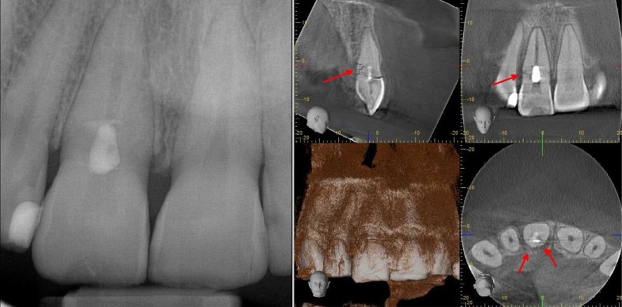 Wurzelkanalbehandlung nach Zahntrauma: Warum, wann und wie?