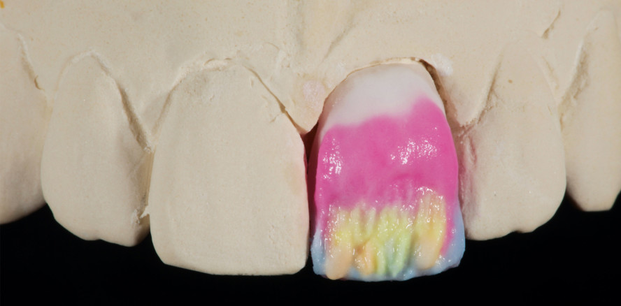 Königsdisziplin: Versorgung eines einzelnen Inzisivus