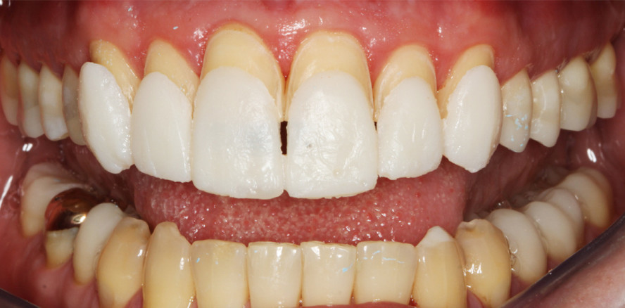 Oberkieferfrontversorgung mit Presskeramikveneers