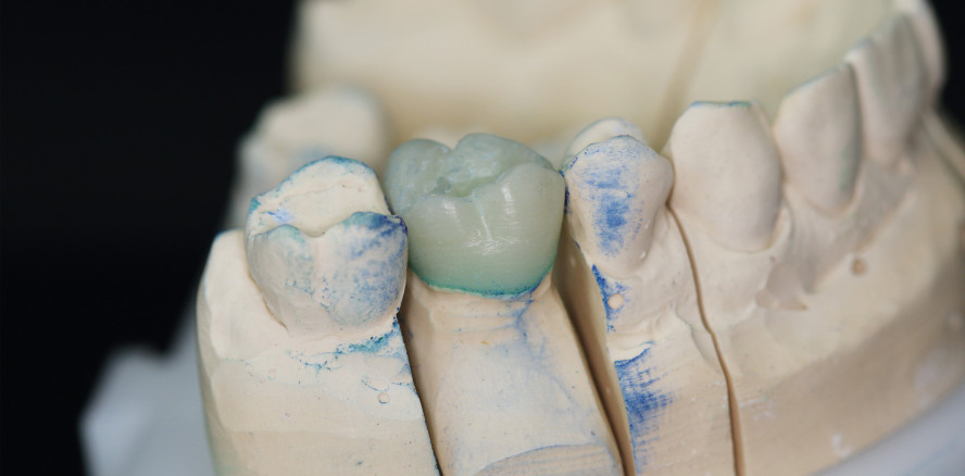 Im Teamwork zur perfekt passenden Krone