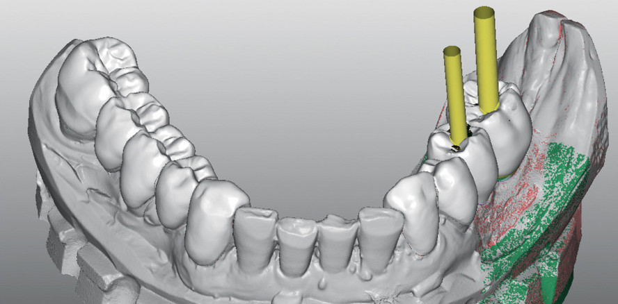 Komplexe ästhetische Rehabilitation des funktionsgestörten Kauorgans