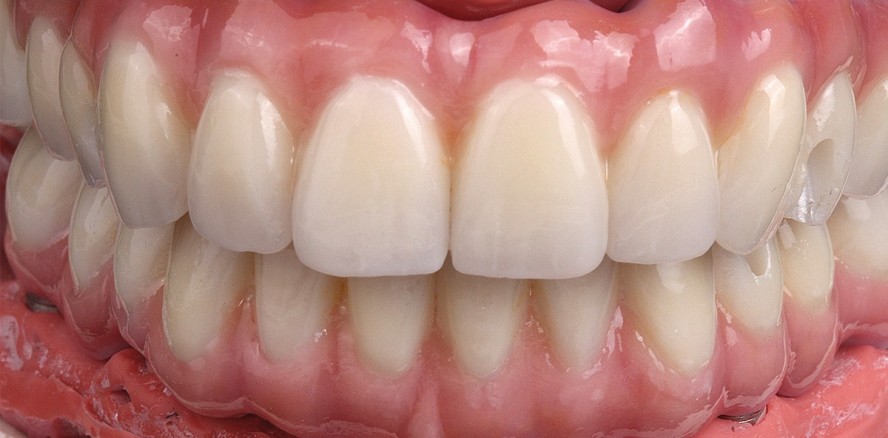 Zahnimplantate – Von der Planung zum ästhetischen Gesamterfolg