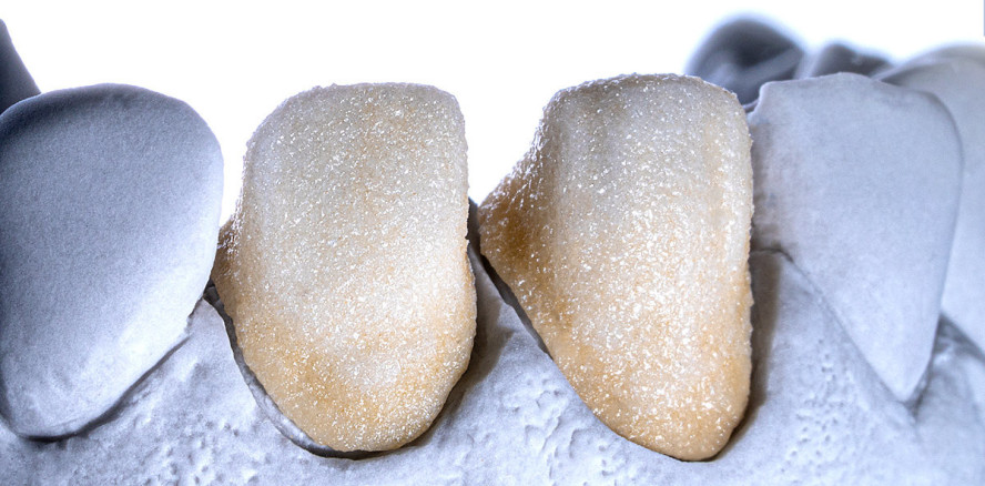 Neutralisierung mittels maskierender Vollkeramikkrone