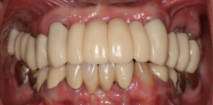 Zahnfarbene Kunststoffe als Gerüstmaterialien bei Zahnersatz