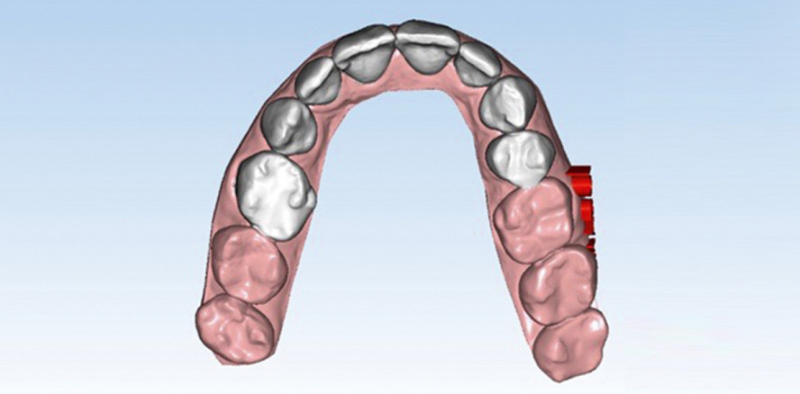 Effektive Zahnstellungskorrektur im Frontzahngebiet