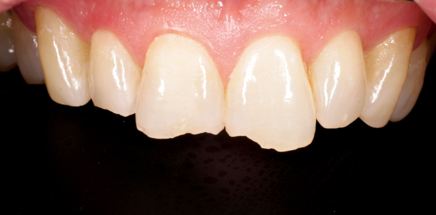 Direkter Aufbau nach einem Zahntrauma mit Composite-Füllung