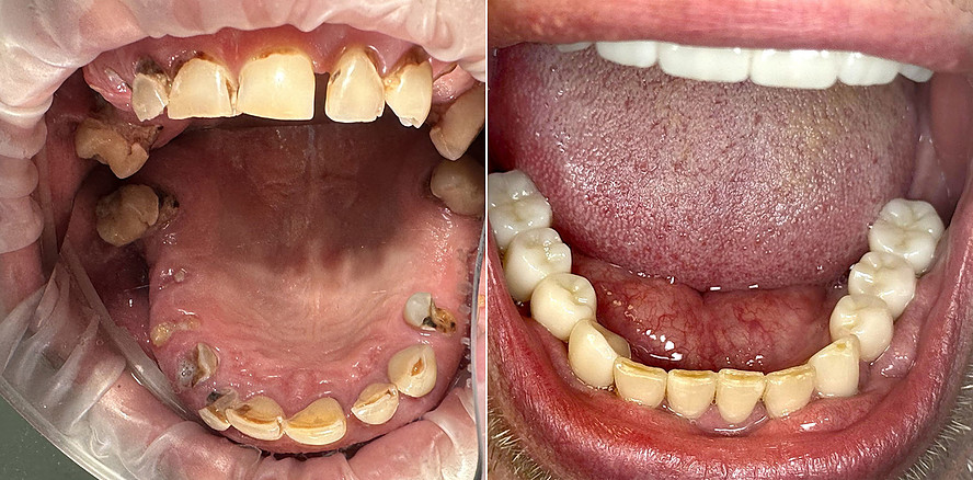 Zeit- und kosteneffektive Implantattherapie bei Zahnarztangst