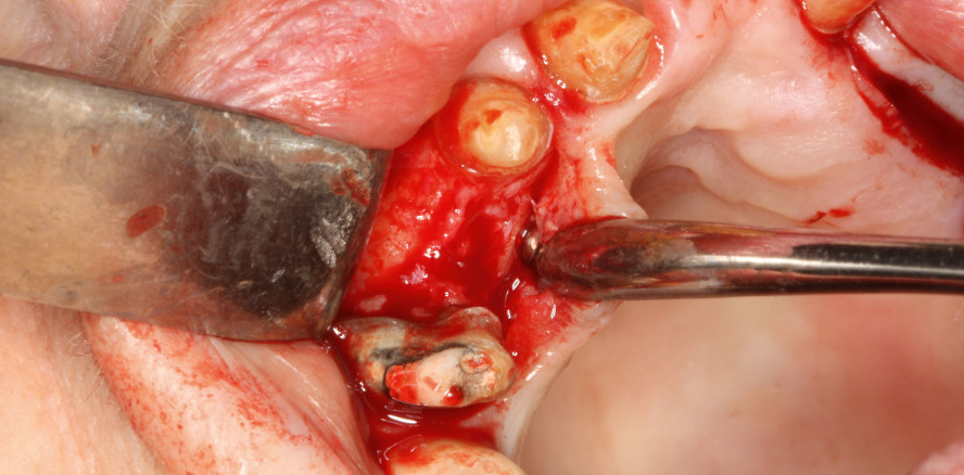 Die abnehmbare Versorgung in der Alterszahnmedizin