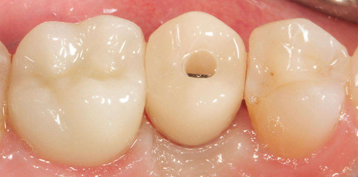 Implantatgetragene Kronenversorgung aus Hybridkeramik