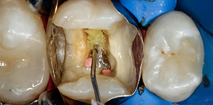 Universaladhäsive: Ein Adhäsiv für alle Indikationen