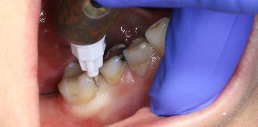 Intraligamentäre Anästhesie mit adrenalinfreiem Articain