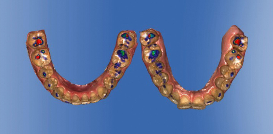 Alignerfertigung digital und zukunftsweisend