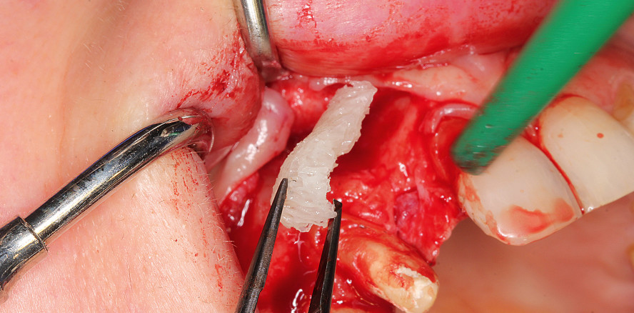 Allogener Knochenblock für die Augmentation im Frontzahngebiet