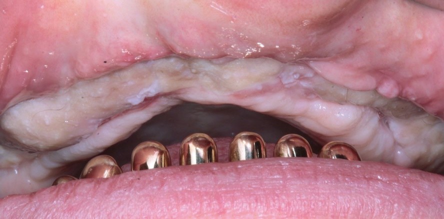 Implantatversorgung bei extremer Alveolarkammatrophie