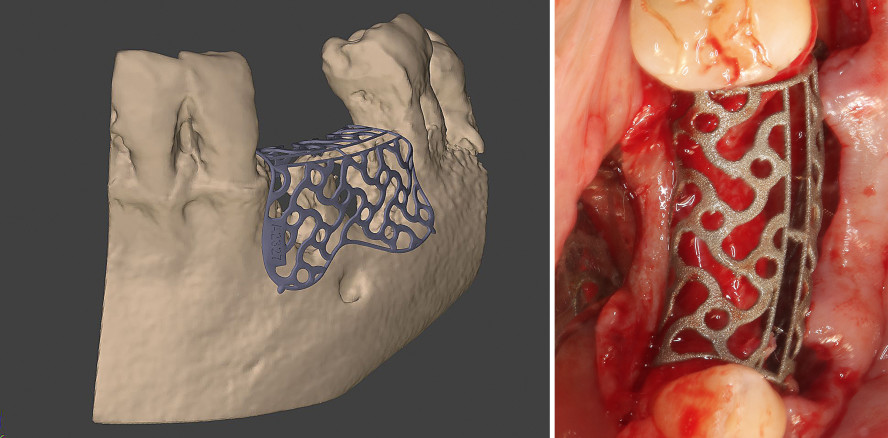 Augmentation des Hart- und Weichgewebes mit 3D-Planung