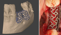 Augmentation des Hart- und Weichgewebes mit 3D-Planung