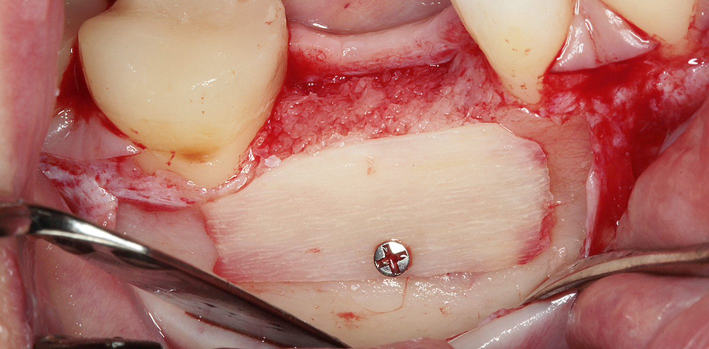 Augmentationen 3.0 – Allogen als Goldstandard?