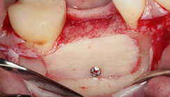 Augmentationen 3.0 – Allogen als Goldstandard?