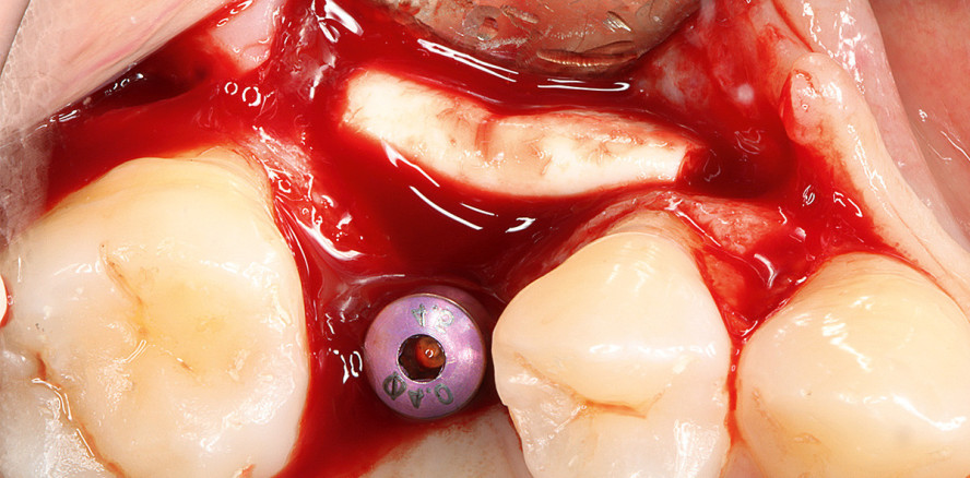 Korrektive Konturaugmentation eines residualen Implantatdehiszenzdefekts