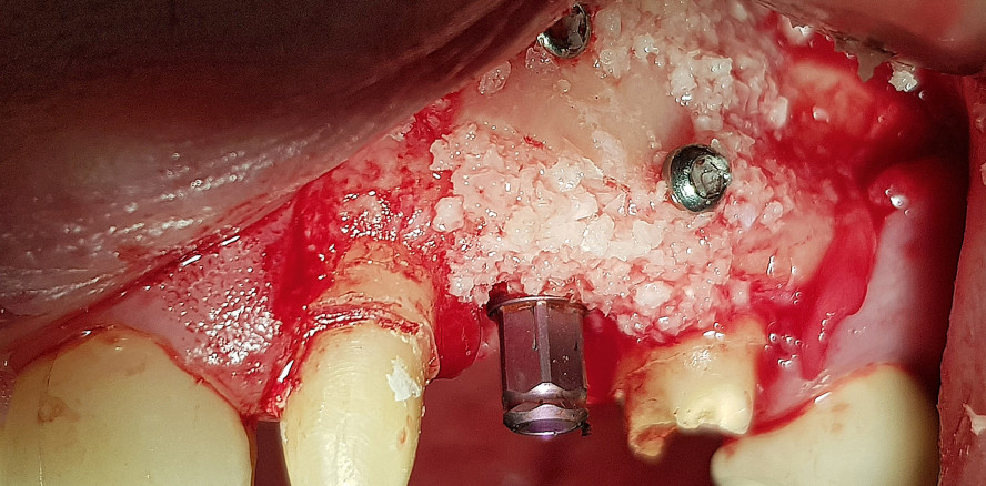 Augmentation eines Oberkieferschaltlückendefekts