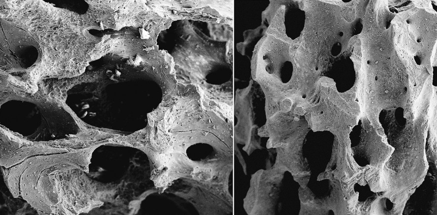 Einsatz von Knochenaufbaumaterial porciner Herkunft