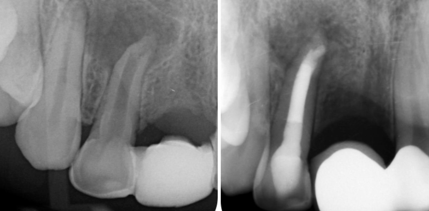 Ausgedehnte apikale Osteolyse mit orthogradem MTA-Verschluss
