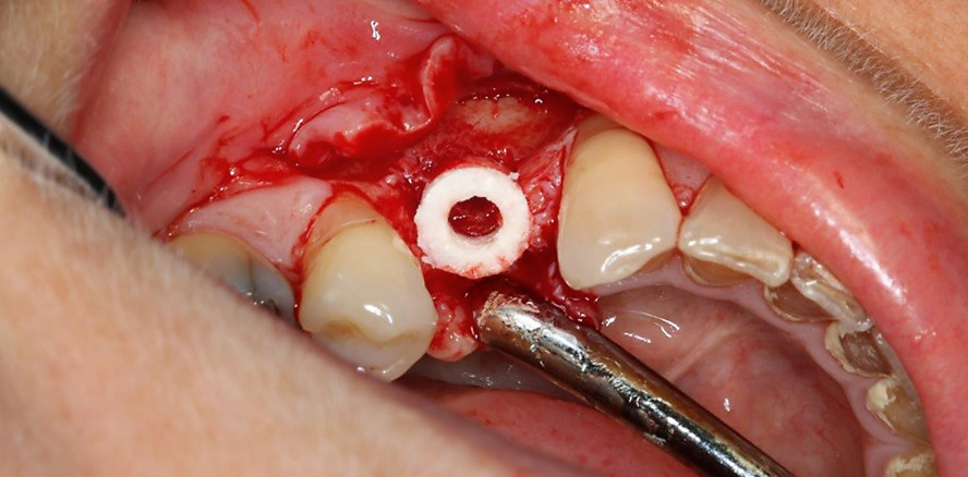 Kieferkammaugmentation mithilfe eines allogenen Knochenrings