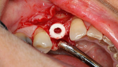 Kieferkammaugmentation mithilfe eines allogenen Knochenrings