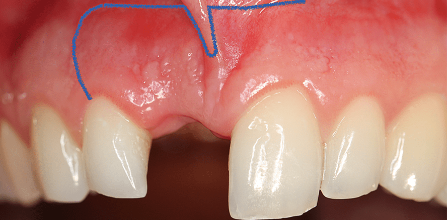 Periimplantitis: Behandlung einer stark resorbierten Maxilla