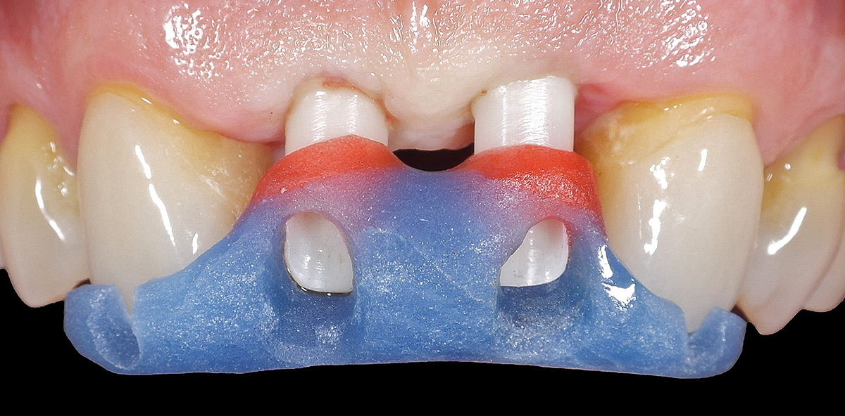 Erfolgsfaktoren für Implantate in der ästhetischen Zone