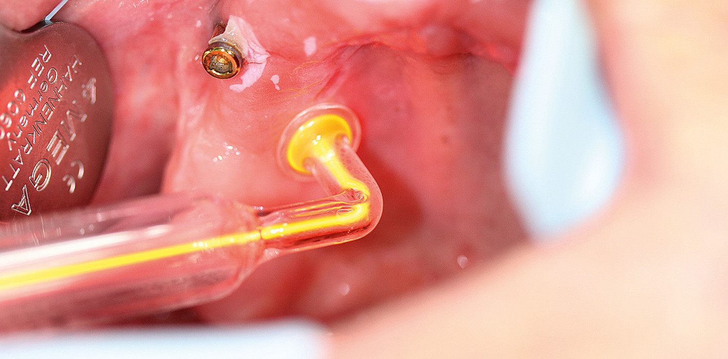 Klinische Behandlungen mit Plasma