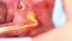 Klinische Behandlungen mit Plasma