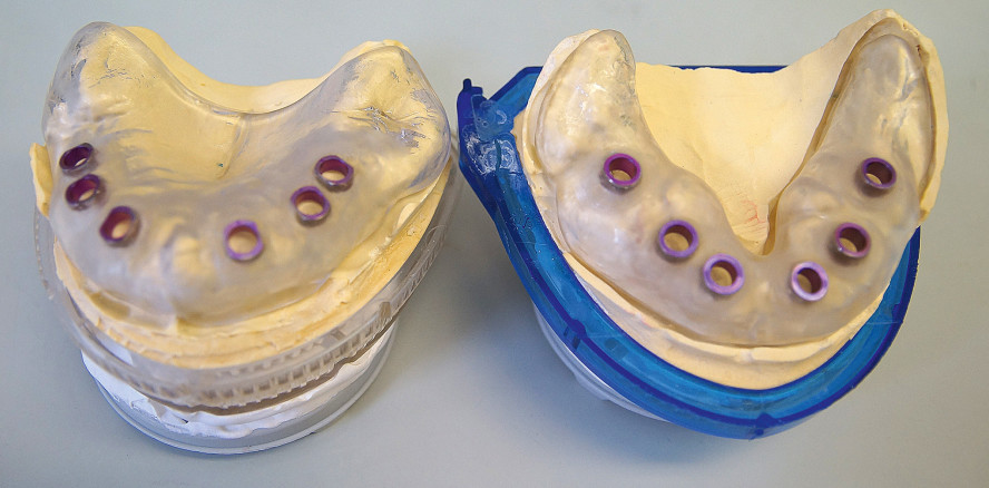 Computergestützte minimalinvasive implantologische Rehabilitation