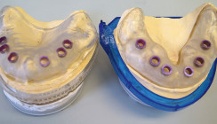 Computergestützte minimalinvasive implantologische Rehabilitation
