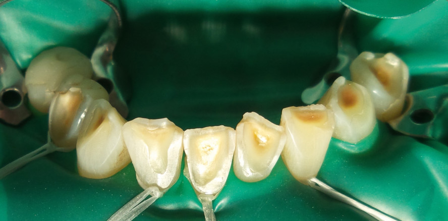 Direkte Bisshebung mit Komposit – ganz ohne Laborkosten