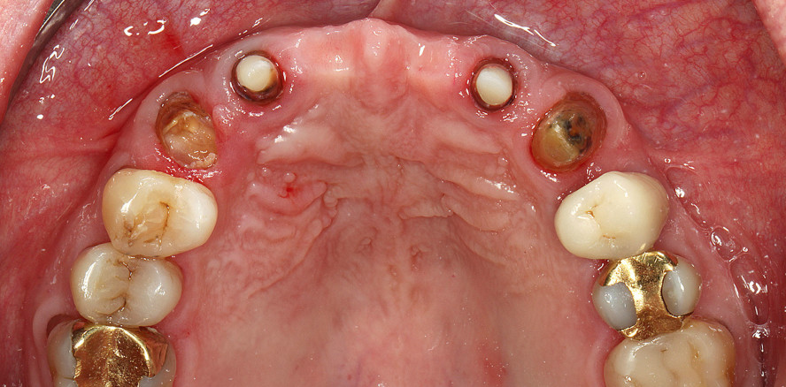 Insuffiziente Brückenversorgung im Oberkieferfrontzahnbereich