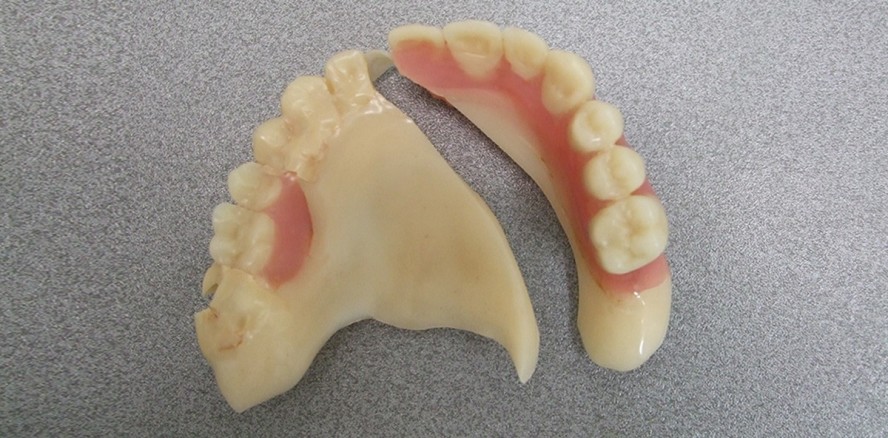 Versorgung eines Bruxismuspatienten bei Metallunverträglichkeit