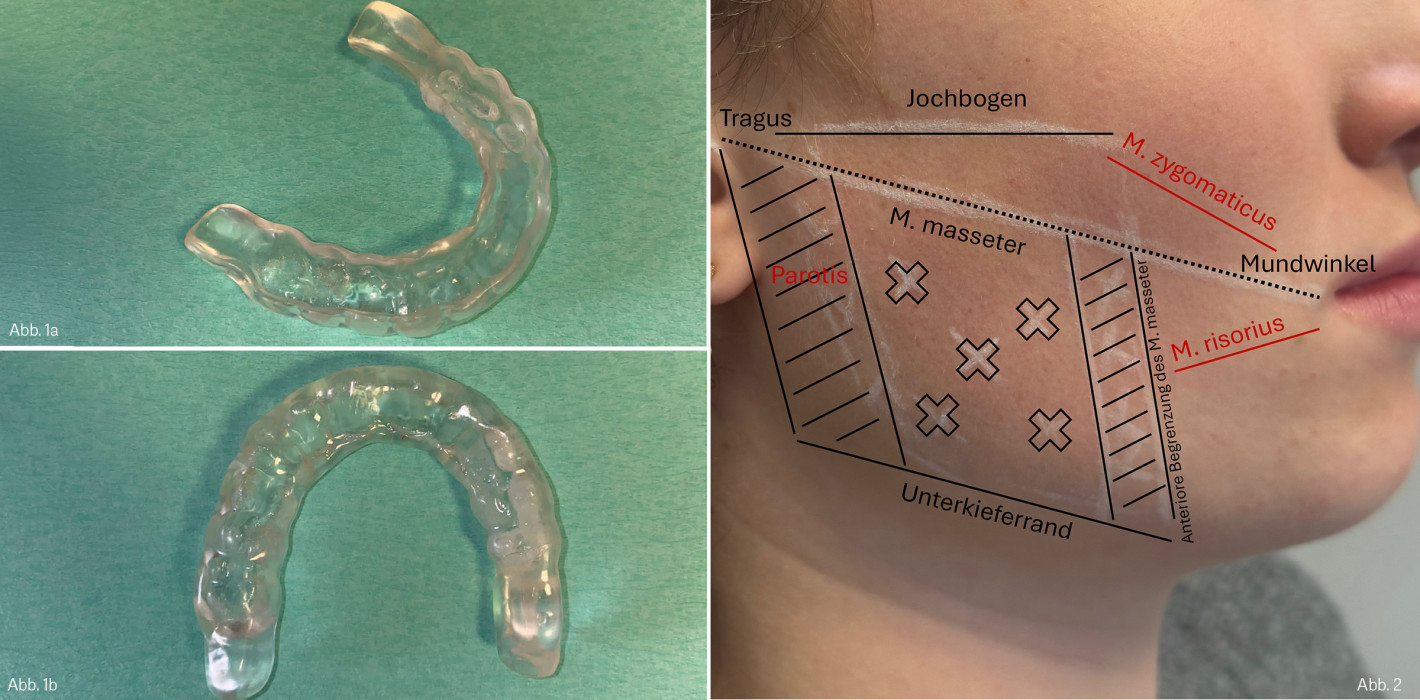 Bruxismus als Risikofaktor für das Implantatüberleben