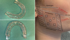 Bruxismus als Risikofaktor für das Implantatüberleben