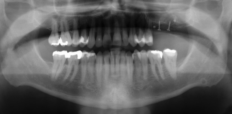 Einsatz eines allogenen CAD/CAM-Knochenblocks